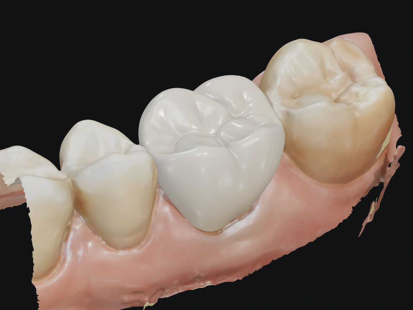 AI crown 1 of four on an upper first molar preparation, between its neighbours
